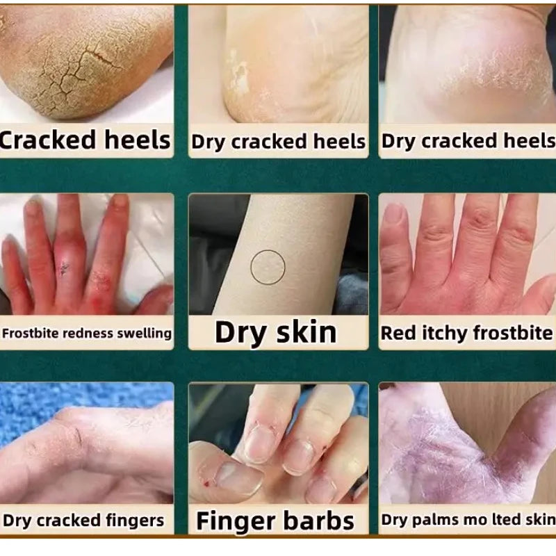 Anti-drying Crack Moisturize Hand Cream Wrinkles Removal Foot Cream Cracked Repair Removal Dead Skin Callus Care Mask Product