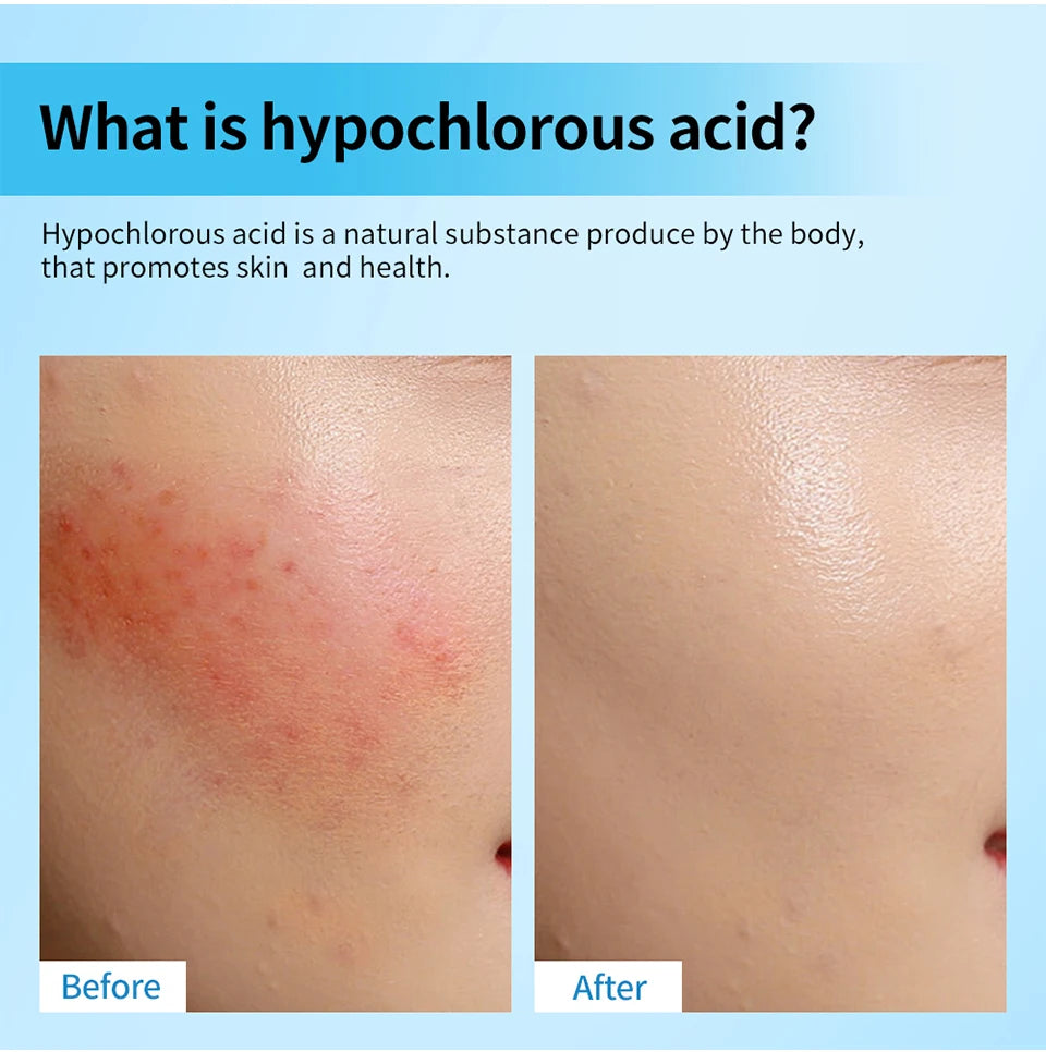 Hypochlorous Acid Facial Spray For daily facial rescue Versatile uses for every skin need Acne Calm Redness Eyelid lrritation